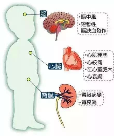 高血壓小知識