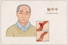 卒中識別早，救治效果好！| 第18個世界卒中