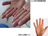 告別“水手”，帶您認識手汗癥
